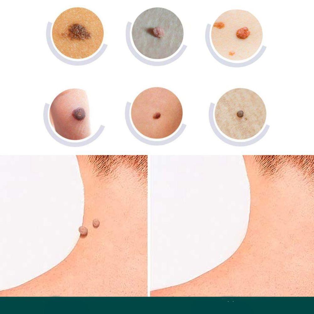DermaClear – Effektives Behandlungset für Akne und Warzen